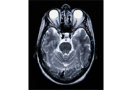 MRI Scan Brain